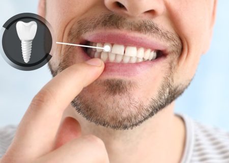 ایمپلنت کره ای یا سوئیسی؟