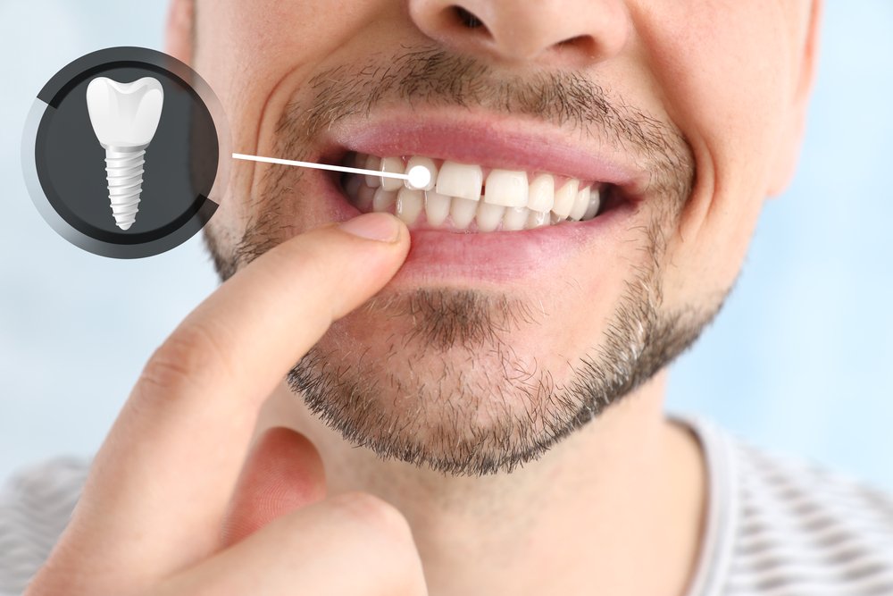 ایمپلنت کره ای یا سوئیسی؟