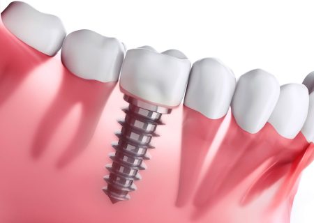 قیمت ایمپلنت دندان در تهران؛ واقعیت‌هایی که باید بدانید