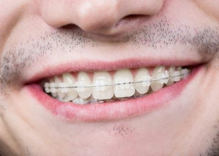 حساسیت به بریس ارتودنسی