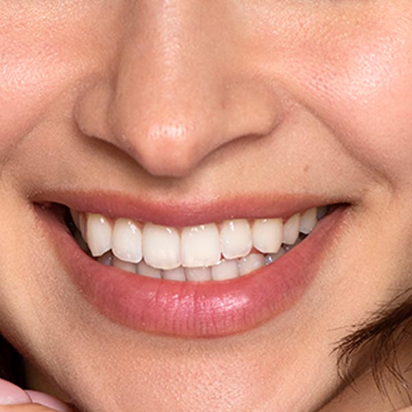 بلیچینگ دندان در شمال تهران؛ لبخندی درخشان، نشانه‌ای از سلیقه و دقت شما